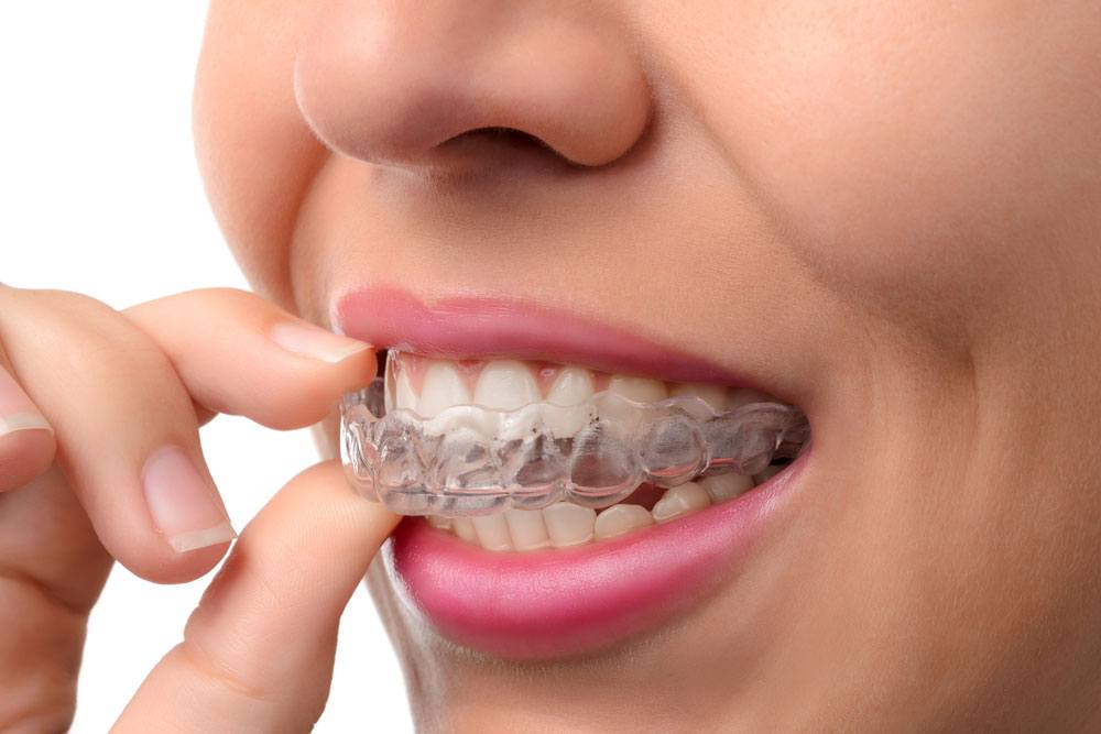 Cosmetic dental treatments: straighten your teeth with nearly invisible  braces - Mississauga Dentist & Dental Office - Jauhal Dental