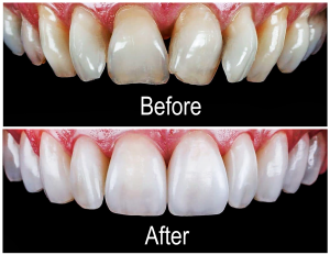 porcelain veneer
