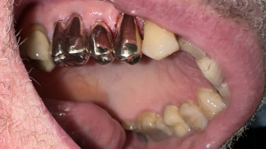 Gold Filling