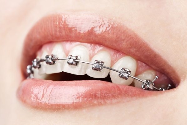 orthodontic treatment