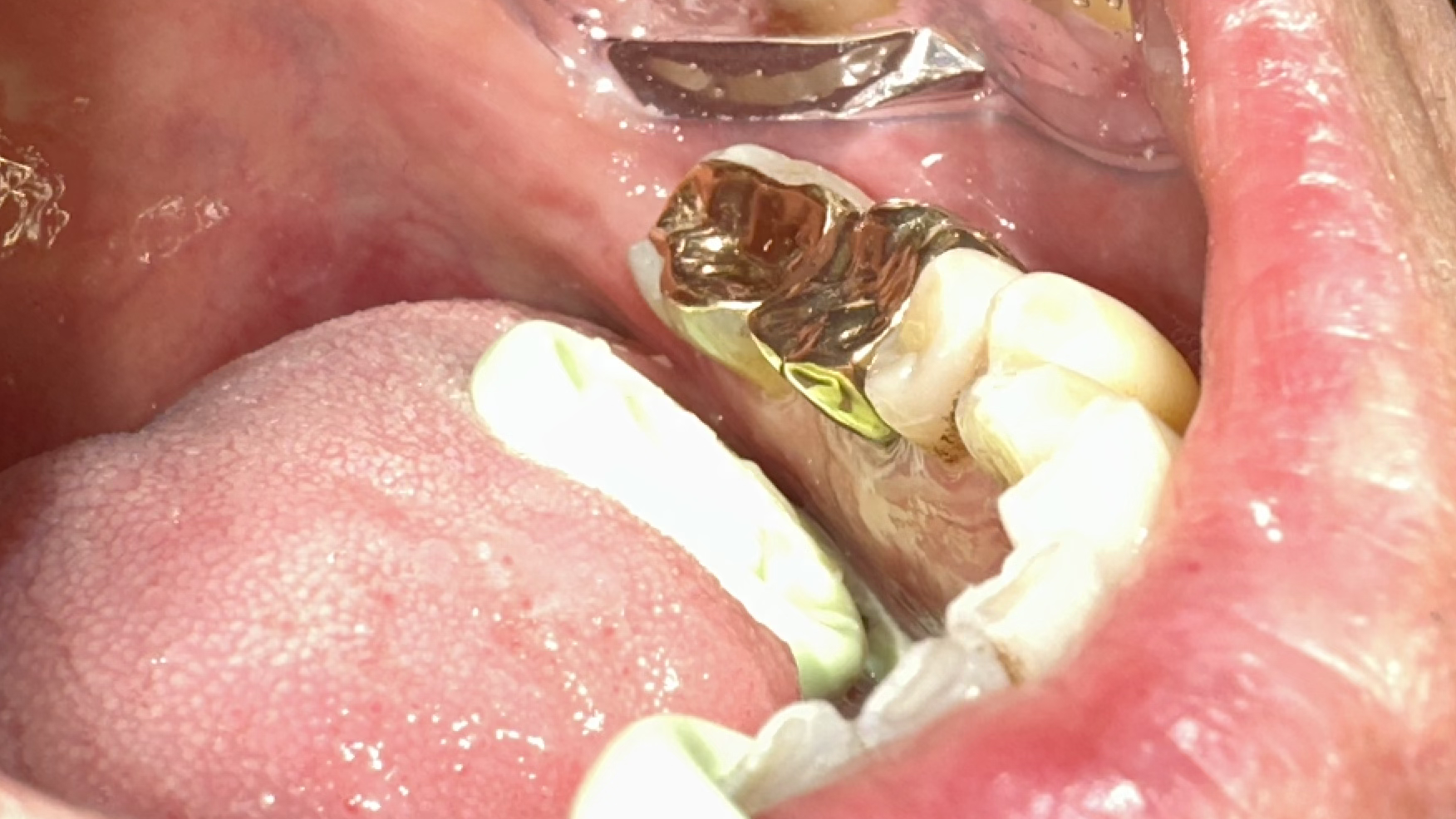 Gold Fillings