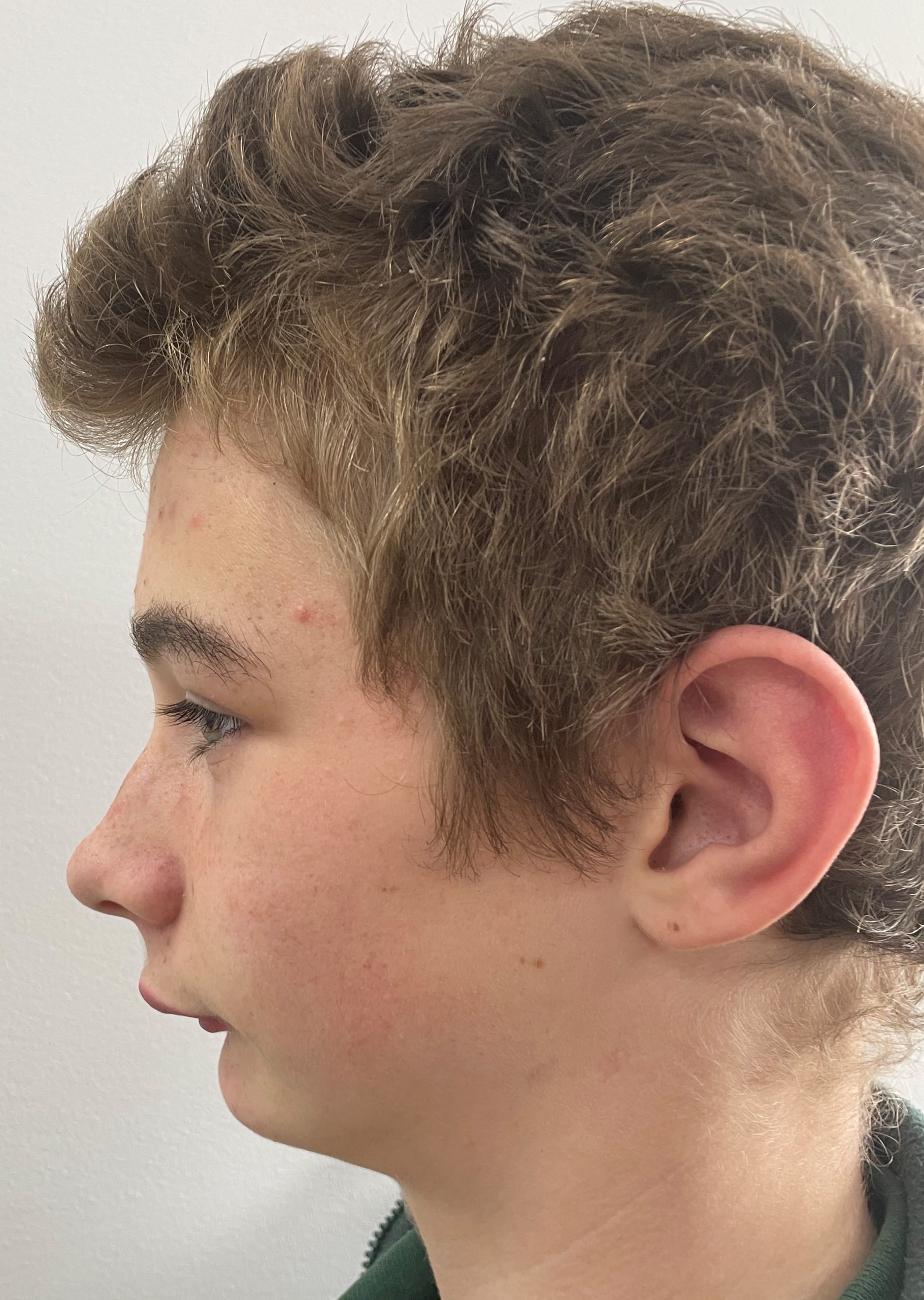 Early orthodontic treatment