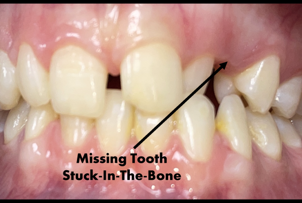 Stuck In The Bone