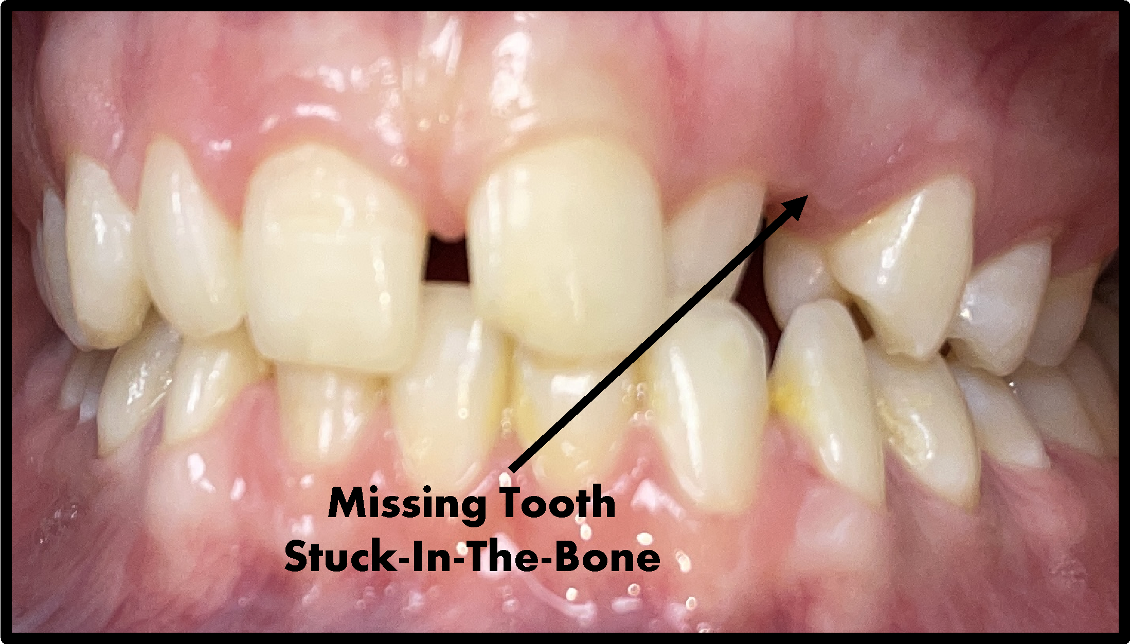 Teeth Stuck In The Bone
