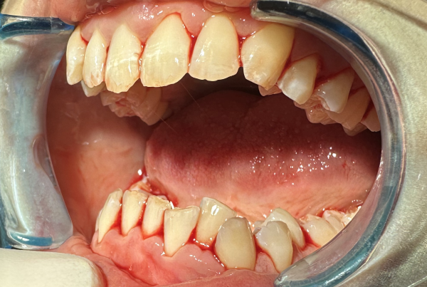 periodontal treatment