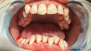 pregnancy gingivitis