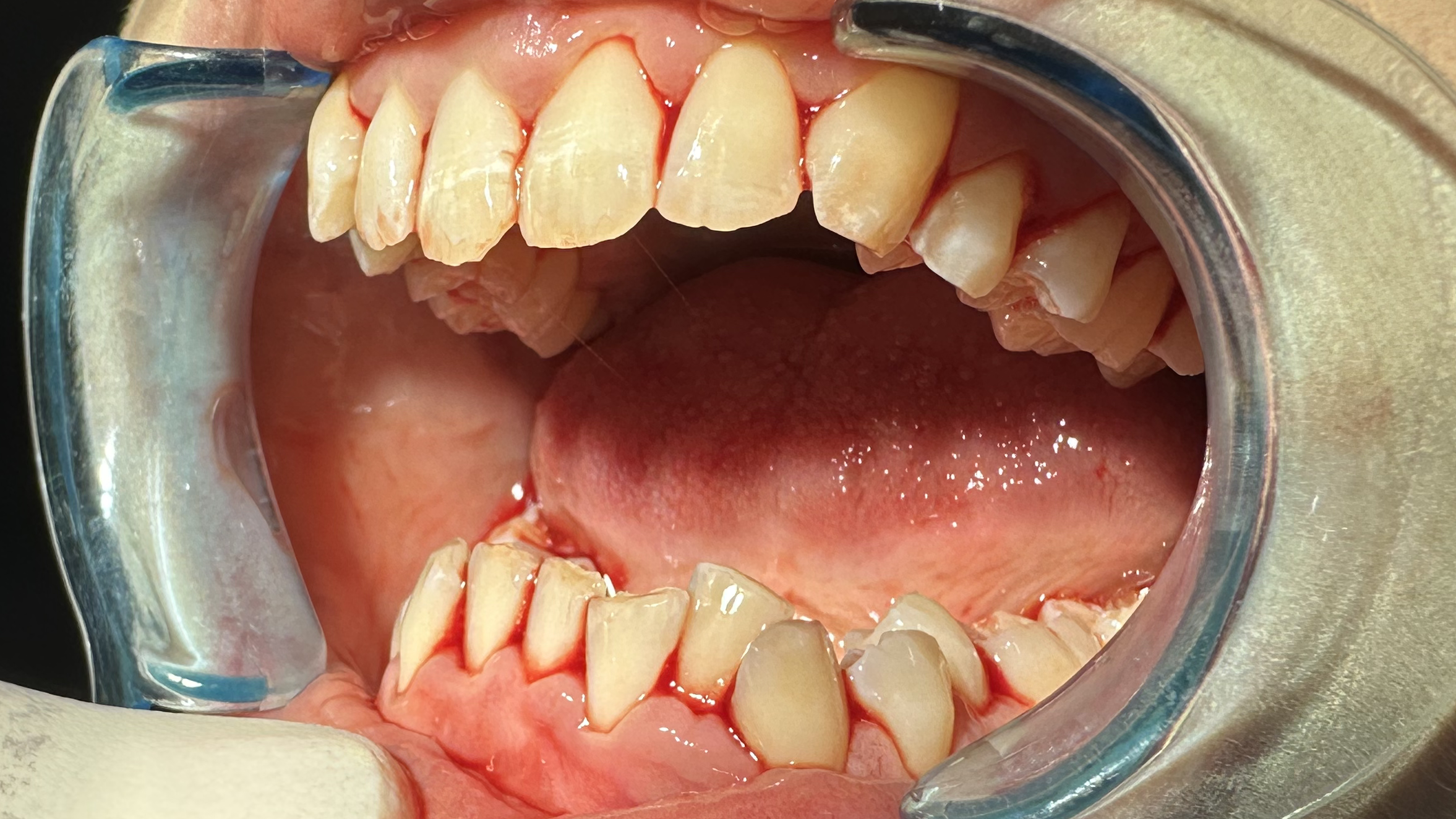 Pregnancy Gingivitis