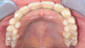 orthodontic retainer