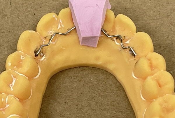 orthodontic retainer
