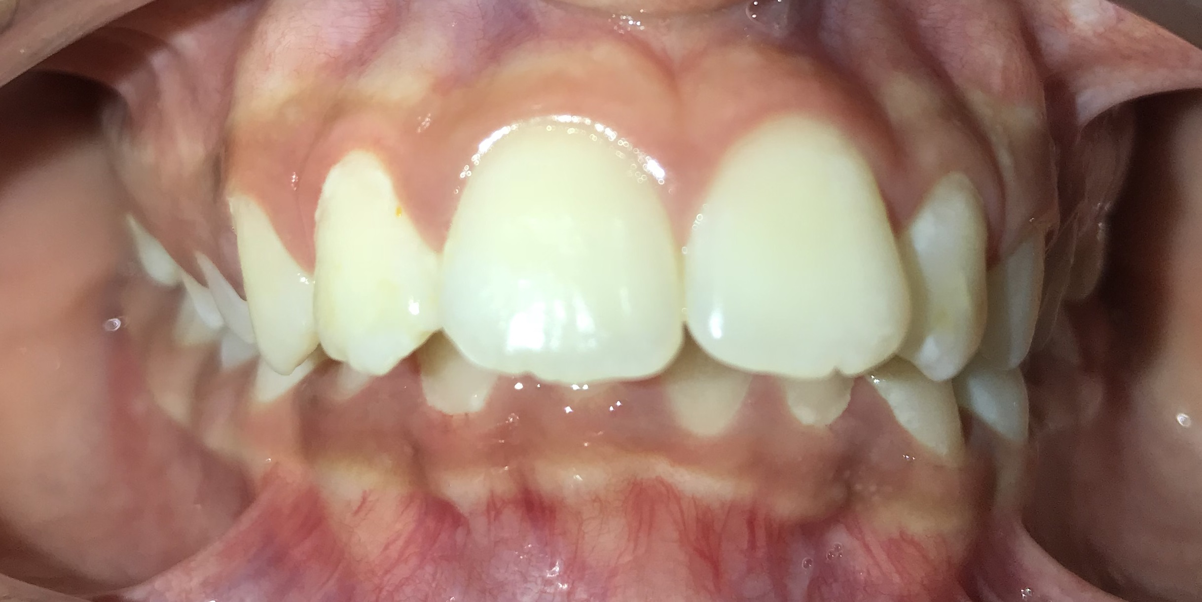 Severe Overbite