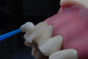 porcelain veneer