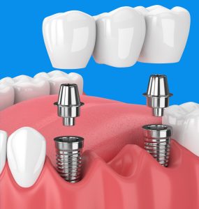 dental-implant
