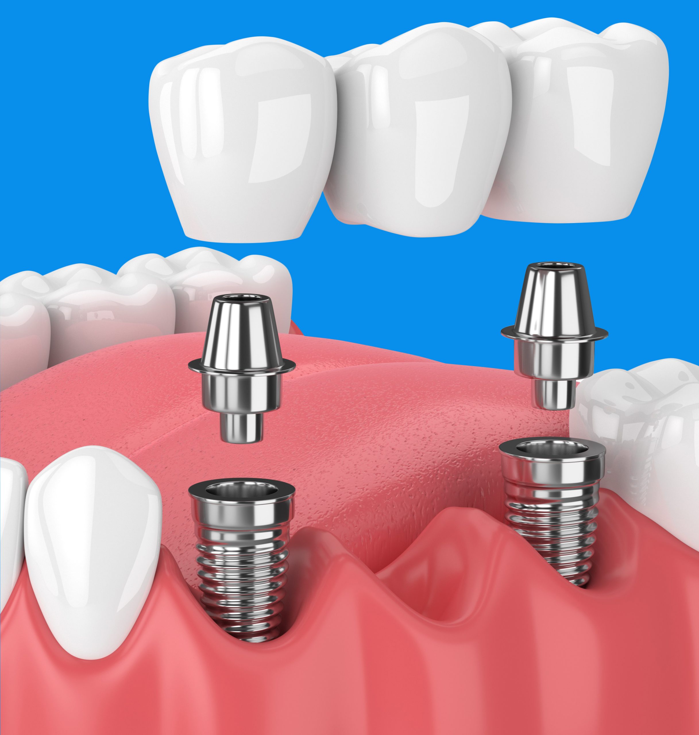 Digital Dental Implants